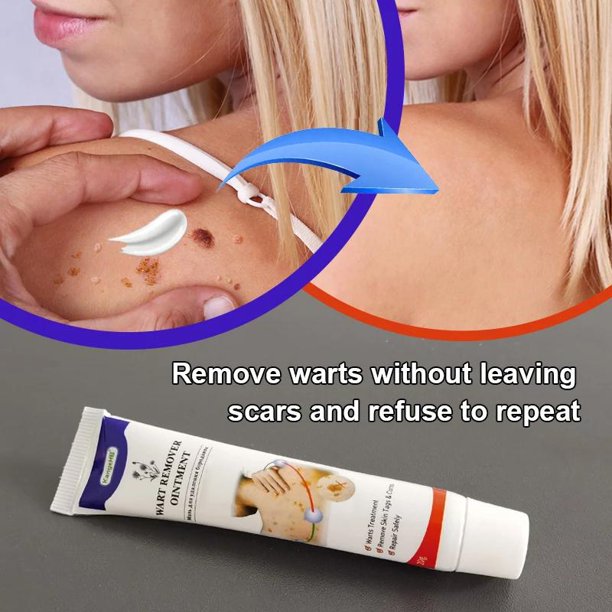 Skin Tag Remover Cream Warts Remover Cream Wart Treatment Ointment Herbal Extract Foot Corn Cream Acne Warts Ointment