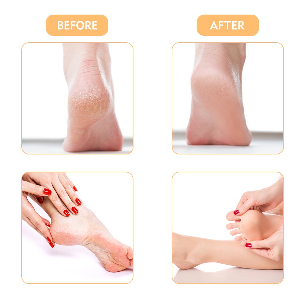 The right way to remove foot callus FULL TREATMENT #2 