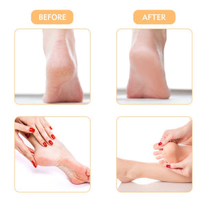 Feet Care Callus Remover Pedicure Pedi for Hard Cracked Skin,Foot Scrubber  Roll